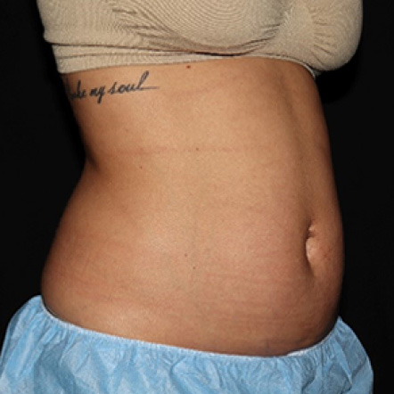 coolsculpting-before