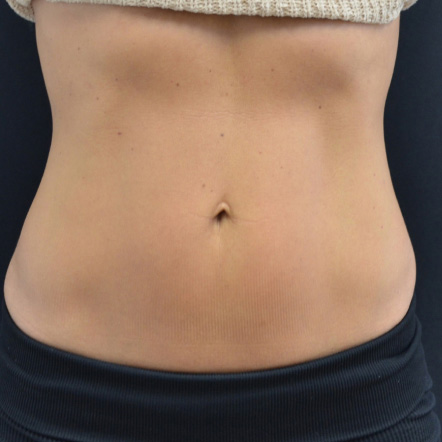 emsculpt-after