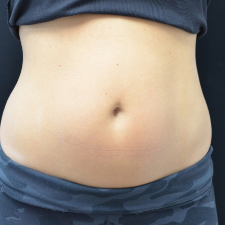 emsculpt-before