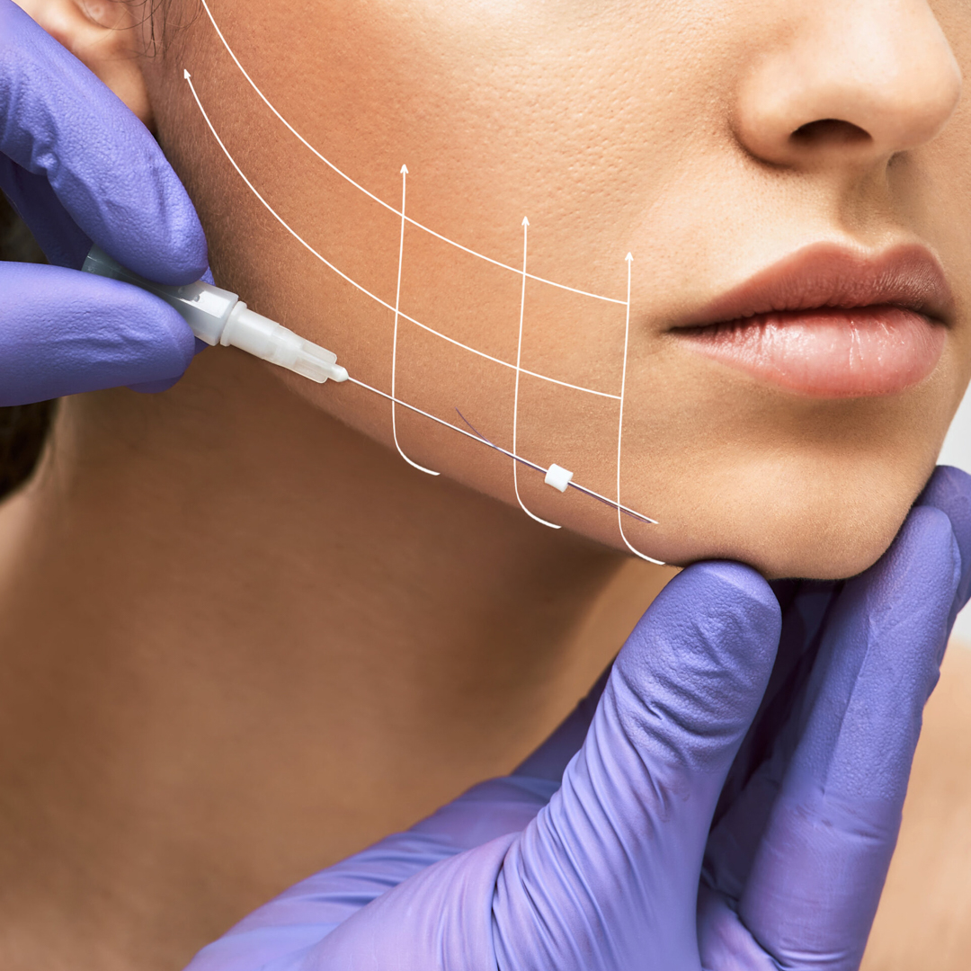 Facial,Lifting,Thread.,Thread,Facelift,With,Arrows,On,Face,For