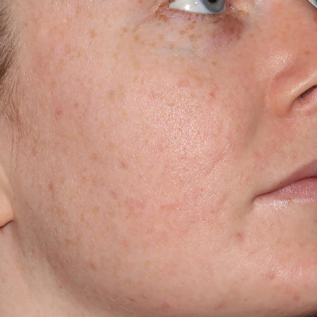 Closeup photo of woman with clear skin after BBL Forever Clear treatment