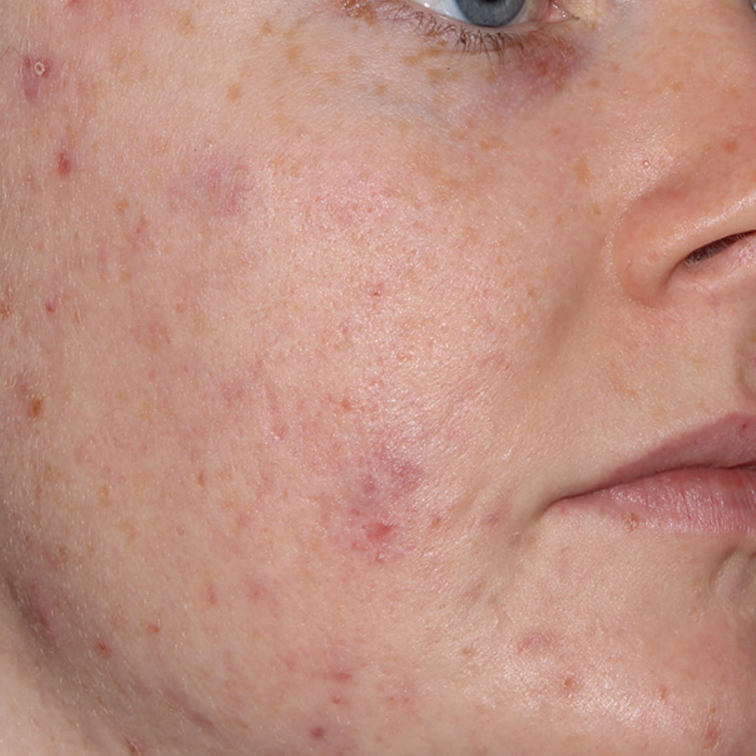 Closeup photo of woman with acne before BBL Forever Clear treatment